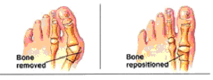 Treating a bunion