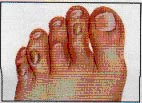 Corns on foot