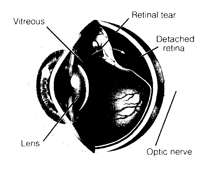 Retinal Detachment