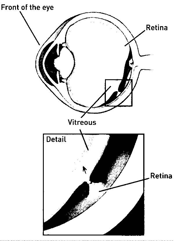 vitreous of eye pulls on retina