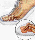 Hammer Toe