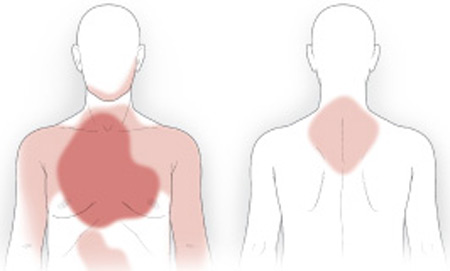 heart attack diagram. Heart attack pain diagram