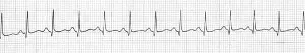 stroke graphic