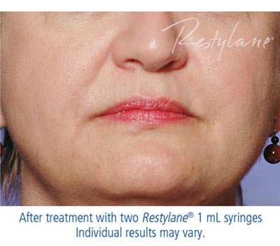 Restylane or Perlane After